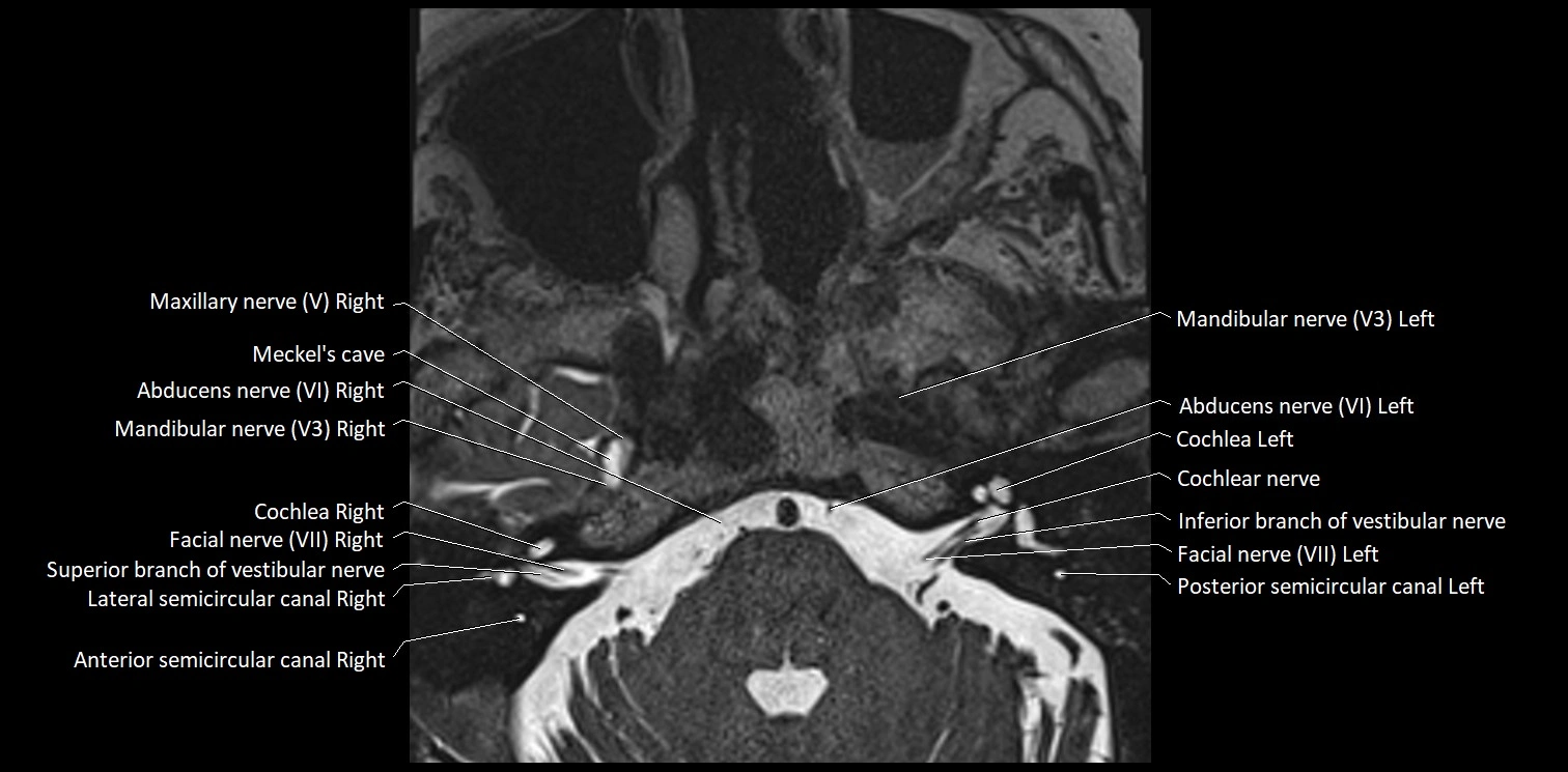 Cranial nerve anatomy axial MRI 3T image 52.webp